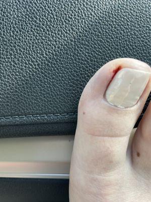 Bleeding toe