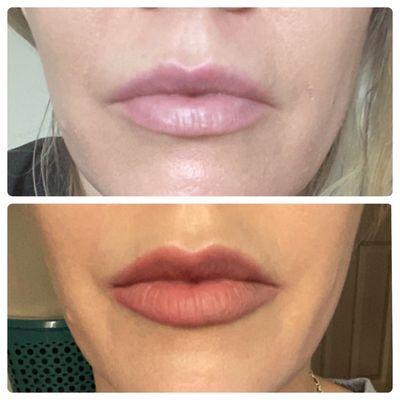 Subtle lip enhancement with outer corners lifted