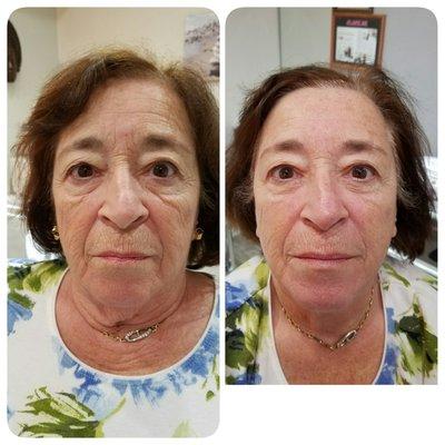 Amazing befire and after with microcurrent the best way to get a non invasive facelift at Mia's Spa!