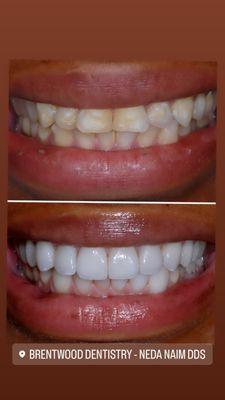 Upper and lower Porcelain Veneers...the smile of your dreams in 2 visits!