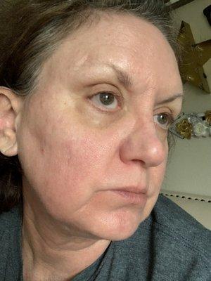 59.5 years old w/rosacea...annoying to say the least