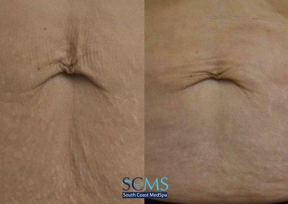 Morpheus8 Skin Treatment - Stomach Skin Tightening