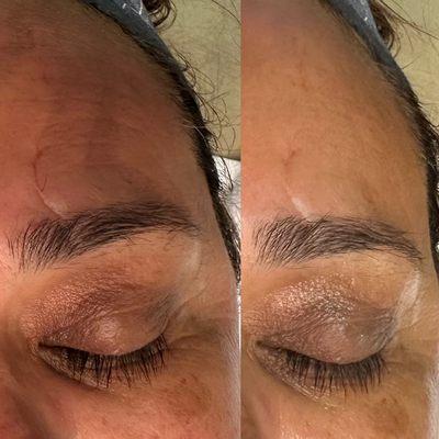 Jetplasm- 15 min session. Brightens skin and softens look of scars