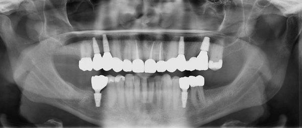 Implants and crowns completed by Dr. Martin