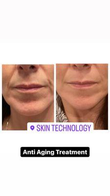 Anti aging treatment