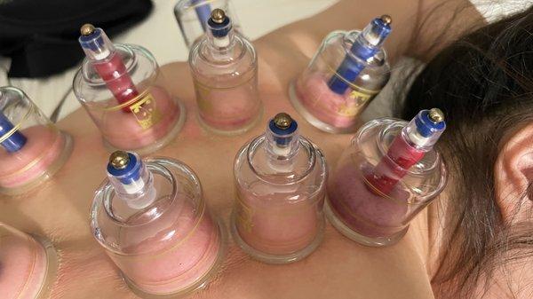 Cupping