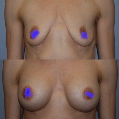 Before and 1 year after breast augmentation. Mother of 2 wanted return of shape and volume after having children.