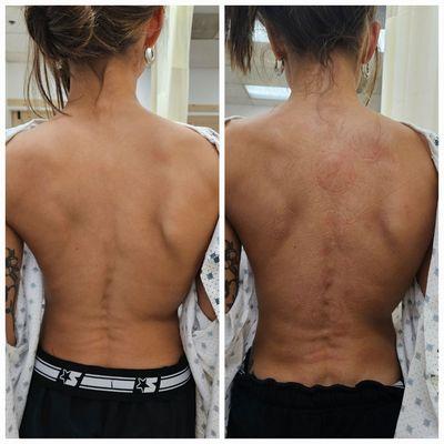 Scoliosis treatment