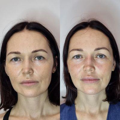 Before/after 1 treatment