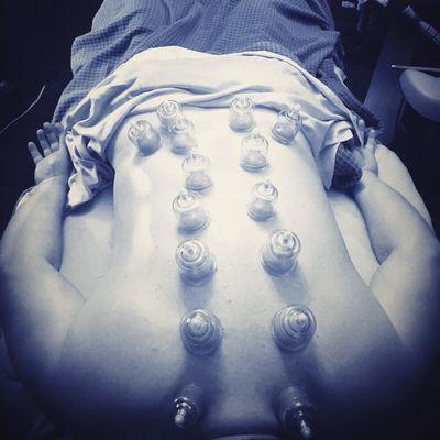 Cupping Therapy is a form of alternative medicine to treat pain,deep scar tissues in the muscles and connective tissue.