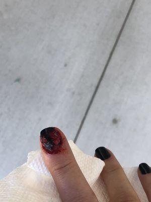 Horse bite accident.