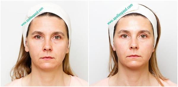 Before and after:  Face Endermologie treatment followed by the Hydrafacial  treatment.