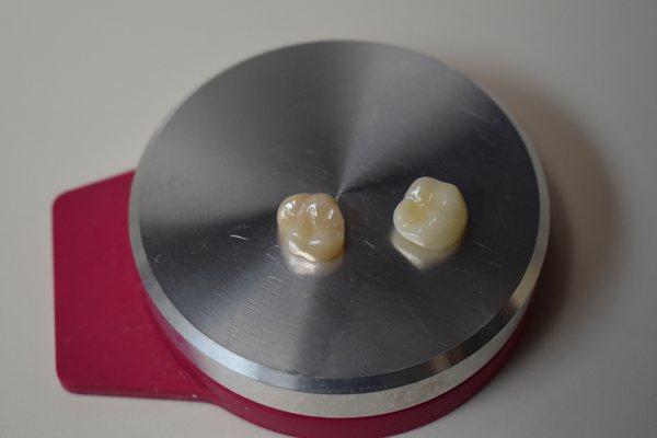 All porcelain crowns. Metal-free restorations using minimal-prep tooth conserving principles.