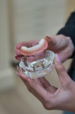 Implant Denture Model