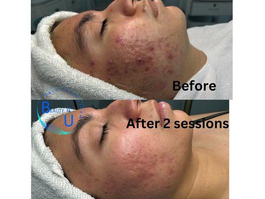 Acne treatment before after! Wow!!