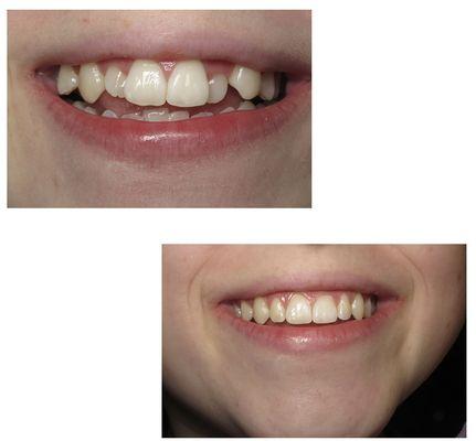 Invisalign before and after