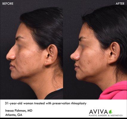 Rhinoplasty or nose surgery results in permanent changes with little downtime, as in this patient shown 1 month after surgery.