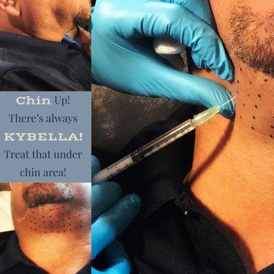 First non-surgical treatment used for the permanent removal of chin fat under the neck area!