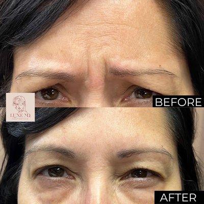 Anti-wrinkle treatment