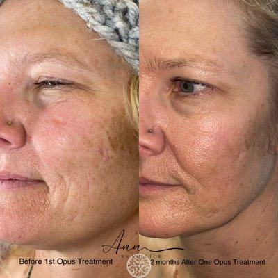 Before and After One Opus Treatment