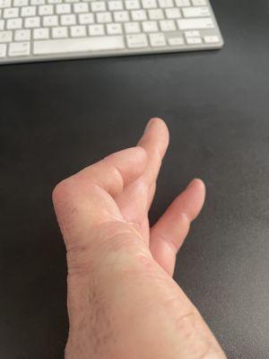 How my finger looks on 3.25.2024.