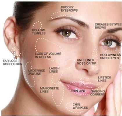 Areas that can be treated with Botox, Dysport, and dermal fillers.