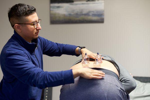 Active cupping technique