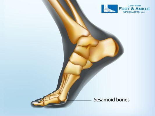 Foot Sesamoid Bone Fracture Treatment in Boca Raton, Florida