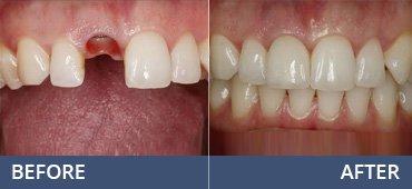 Before & After Dental Implant