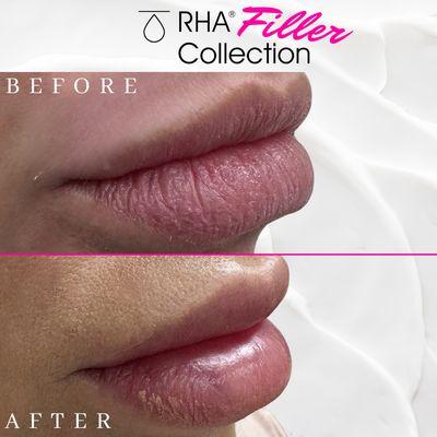 Before and after lip filler