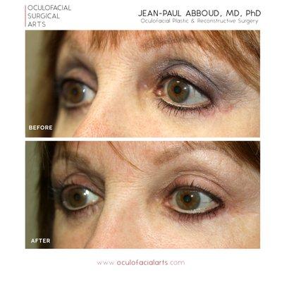 Lower Eyelid Revision Surgery and Retraction Repair via Midface Lift and Canthoplasty