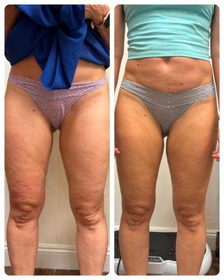 Endospheres Cellulite Treatment