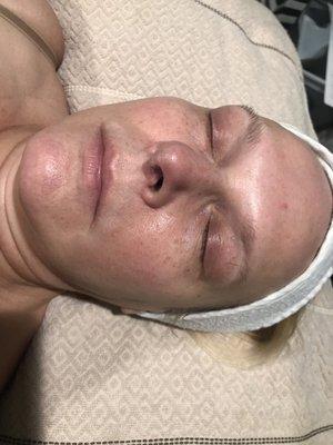 Skin care microdermabrasion.