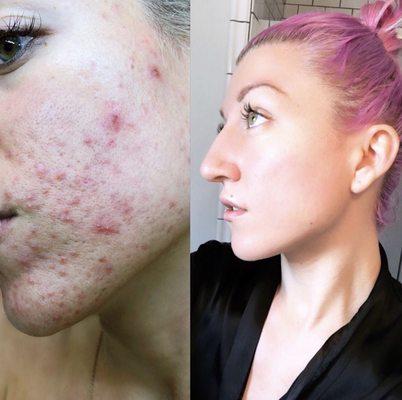 My skin before and after going to Marci's Skincare!