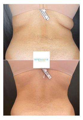 EmsculptNEO transformation at Renewlogie. Patient completed a series of 6.