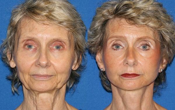 Facelift & Facial Fat Grafting Before & After. Learn more http://www.drgregpark.com/facelift