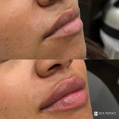 Lip Filler B/A