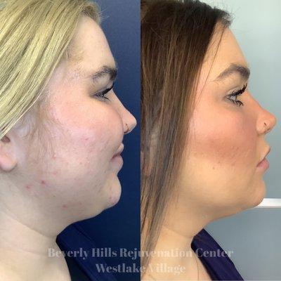 Kybella Double Chin Treatment Result after 1 treatment, 2 more to go