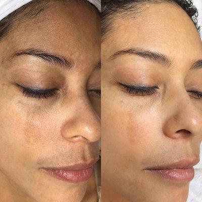 (In Process) Melasma & Pigmentation treated with Environ home care Radiance & Medical Needling.