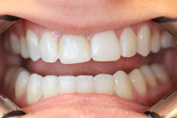 AFTER only 4 months of Six Month Smiles braces, and custom whitening trays.