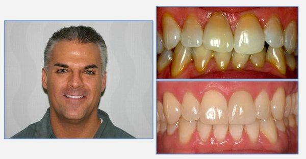 Rob - Veneers to correct antibiotic teeth staining!