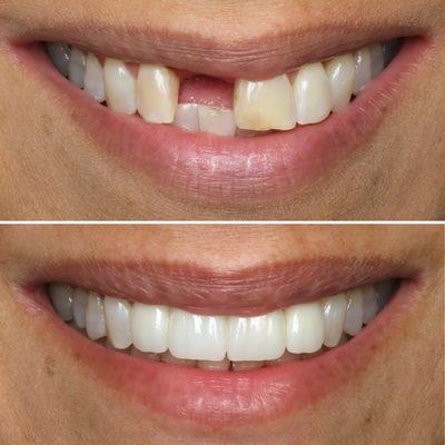 A fixed bridge to restore this patient's smile done by Dr. Rob.