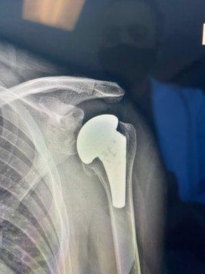 new shoulder. The prosthesis.