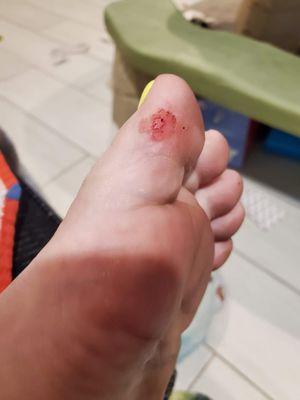 Cut from pedicure