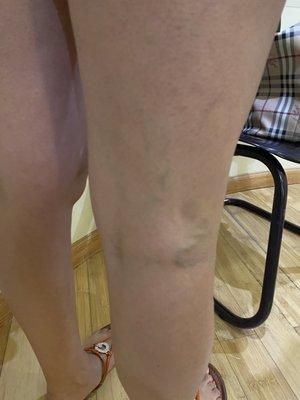 Before Treatment Right Leg