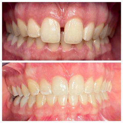 Invisalign Before and After