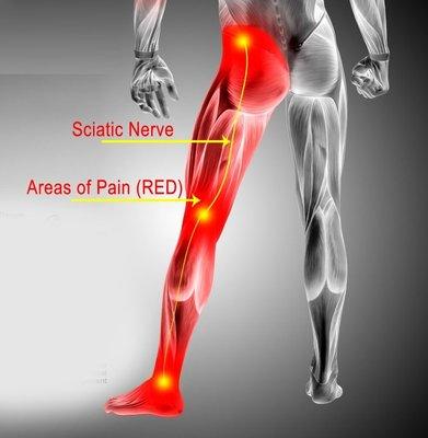 Sciatic pain