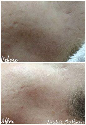 Sculplla treatment for acne scar