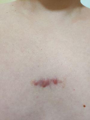 Scar on the center of my chest, over 1 year later