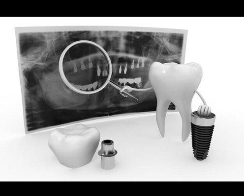 #Dental #Implants